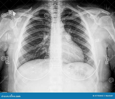 Xray chest stock photo. Image of inside, bronchitis, doctor - 47703642