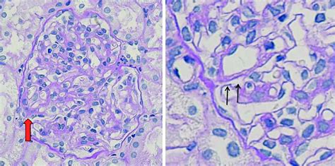 Histologic Findings At 7 Years The Renal Biopsy Specimen Shows