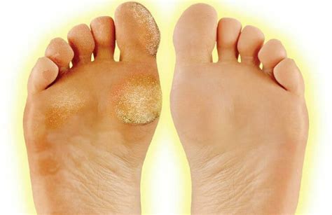 Painful Feet Could It Be Corns And Callus Podiatry First