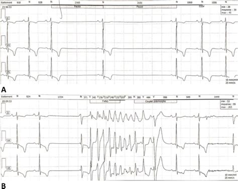 24 Hours Holter ECG Demonstrating The Association Of Sinus Node