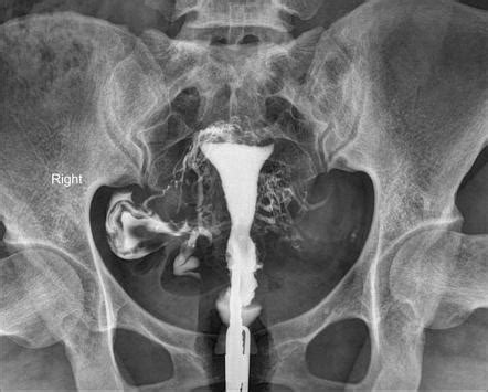 Venous Intravasation On Hysterosalpingogram Radiology Case