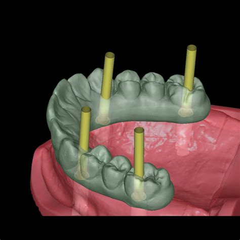 Software Modul Für Dentalimplantologie Zirkonzahn Für Dentallabor