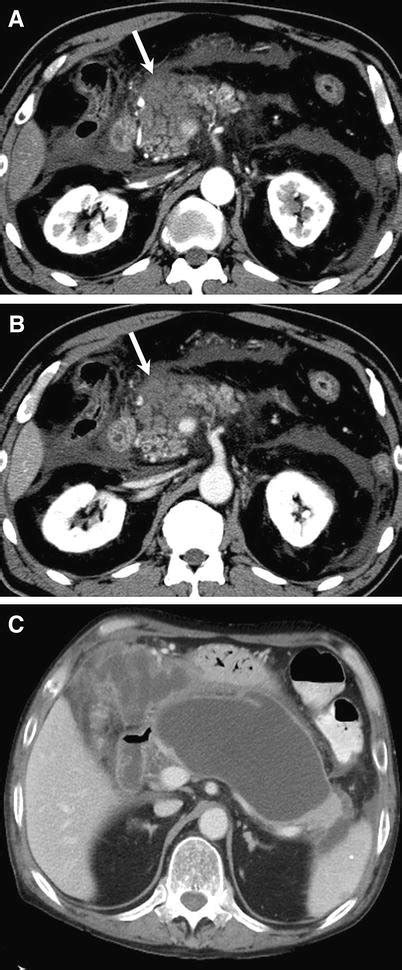 Sixty Four Year Old Man With Acute Necrotizing Pancreatitis A Axial Download Scientific