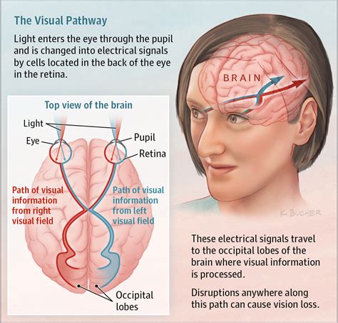 Sudden Vision Loss Ophthalmology Jama Jama Network