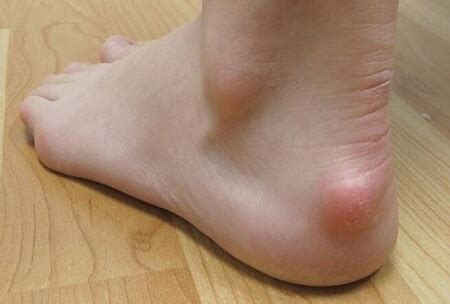 Tiny Bumps On Heel Of Foot Factory Sale Emergencydentistry