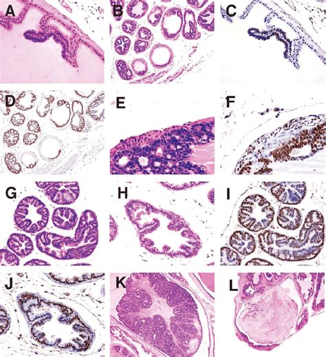 A Anterior Lobe Hande Region Of Focal Epithelial Hyperplasia B