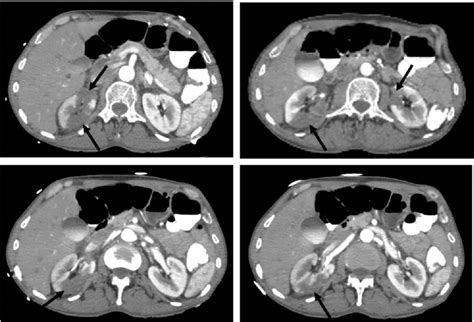 Ct Angiogram Of The Abdomen Reveals Bilateral Renal Infarcts Arrows Download Scientific