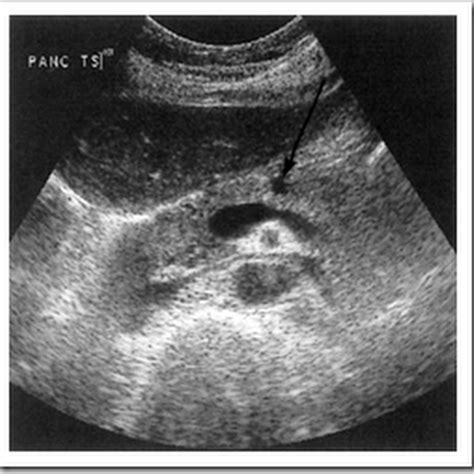 Ultrasound images of Cysts pancreas - Radiology Imaging