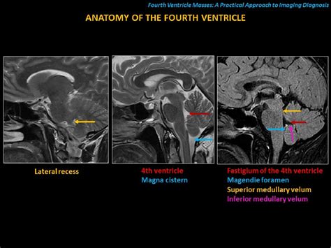 Fourth Ventricle Masses A Practical Approach To Imaging Diagnosis Semantic Scholar