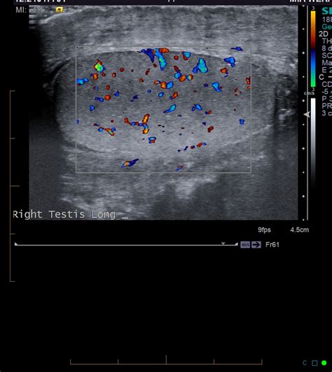 Scrotal Cellulitis Image