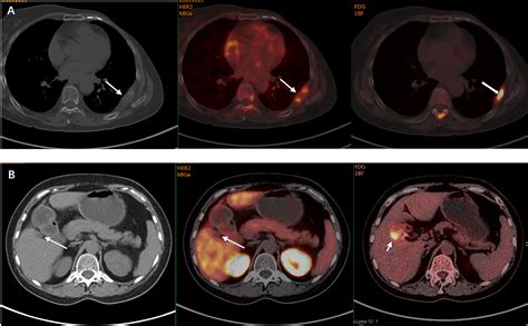 Frontiers Application Of A Novel Ga Her Affibody Pet Ct Imaging In