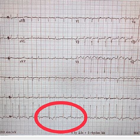 Ecg Revealing Atrial Fibrillation With A Rapid Ventricular Rate Red Download Scientific