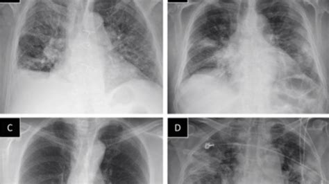 M Health Fairview Implements Chest X Rays To Identify COVID 19 Bring