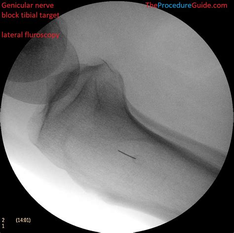 Genicular Nerve Block Fluoroscopy