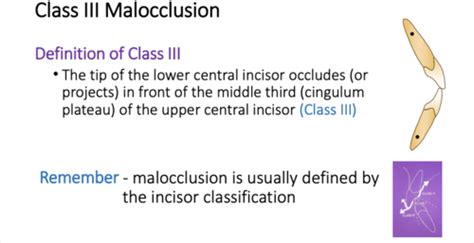 Ortho Tutorial Class Occlusion Flashcards Quizlet