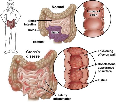 Crohn S Disease GENEGUT