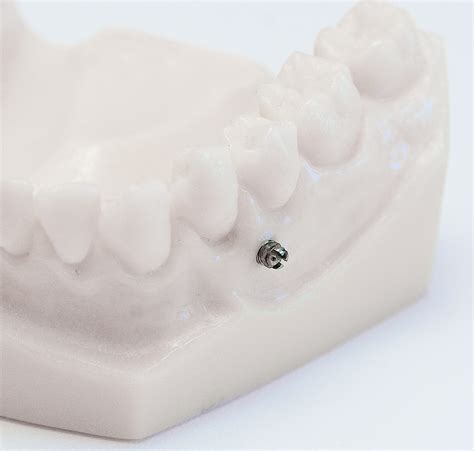 Orthodontische Miniimplantate Kfo