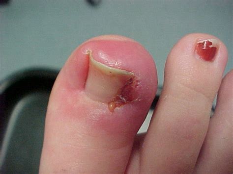 Ingrown Toenail - Treatment, Surgery, Removal, Remedies, Causes, Home Treatment | Diseases Pictures