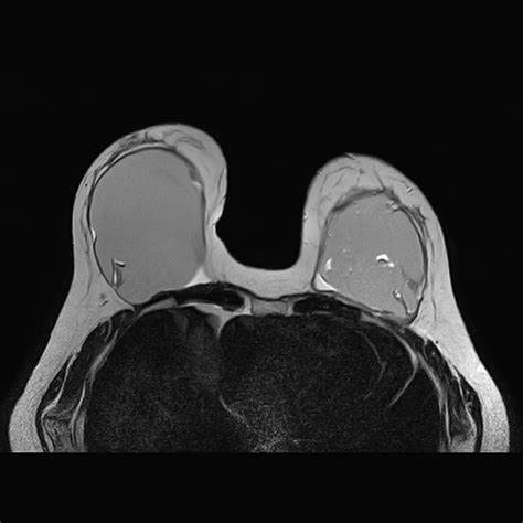 Intracapsular Breast Implant Rupture Image Radiopaedia Org