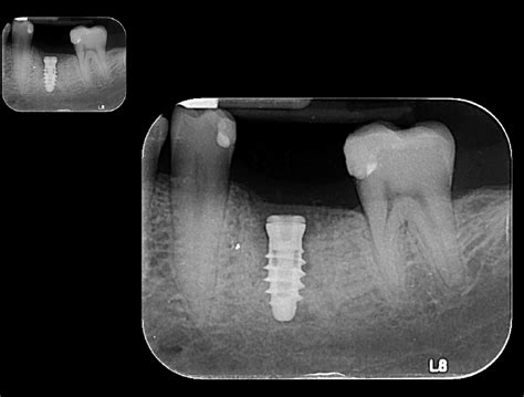 Radiograf As Intraorales Rxm Radiologia Maxilofacial