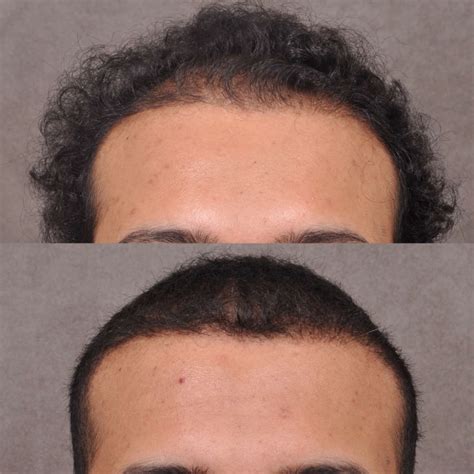 Hair Transplant Hairline Lowering Before Afters Beverly Hills