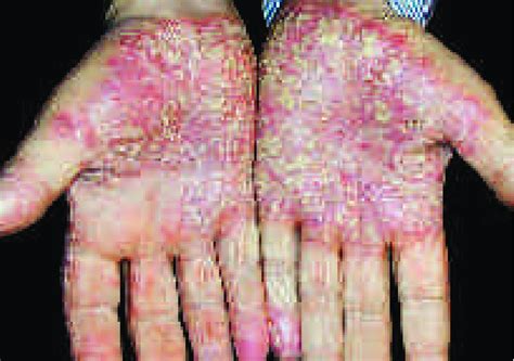 Psoriasis Fingertips