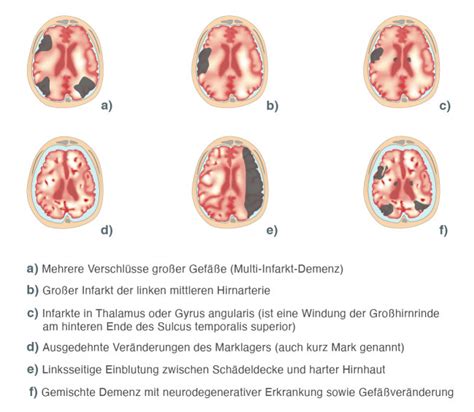 Vaskul Re Demenz Enzephalopathie Alle Infos Tipps