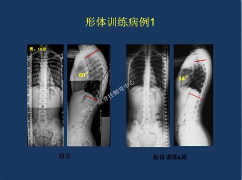 普查形体治疗实例展示广东省新苗脊柱侧弯预防中心 脊柱侧弯新苗基金