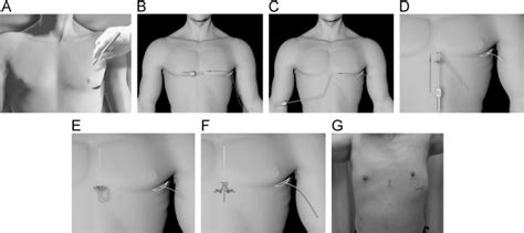 Two Incision Technique For Implantation Of The Subcutaneous Implantable Cardioverter