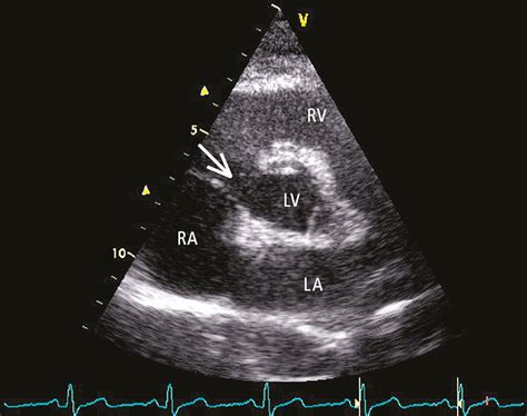 Figure Transthoracic Echocardiography Tte Parasternal