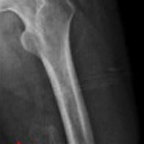 Radiographic Image Demonstrating Heterotopic Ossification Within The Download Scientific