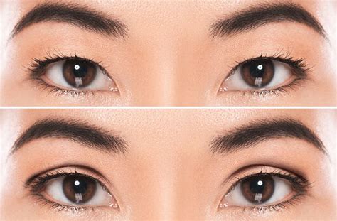 Eyelid Surgery Options For Improving Appearance All About Vision