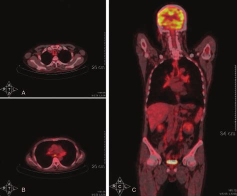 PET CT Fusion Images Of Trachea A And Bronchus Hilar And