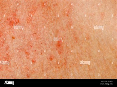 Eruzione Cutanea Allergica Dermatite La Texture Della Pelle Foto Stock