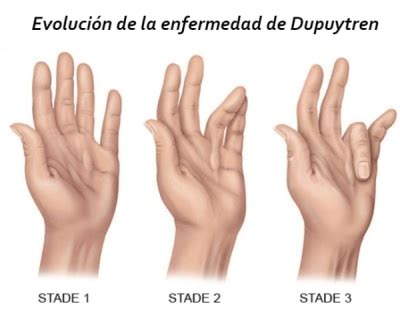 Enfermedad De Dupuytren Cl Nica Planas Cl Nica Planas Barcelona