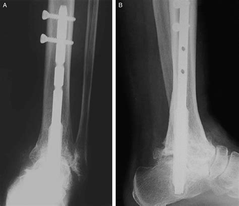 Arthroscopic Tibiotalocalcaneal Arthrodesis With Intramedullary Nail