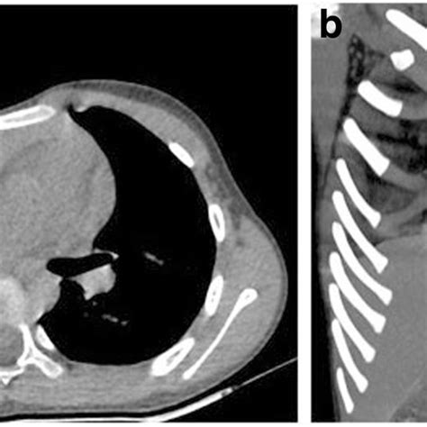 Narrow, long rib cage. | Download Scientific Diagram