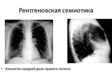 Рентгенодиагностика ателектаза легких Кафедра лучевой диагностики и лучевой
