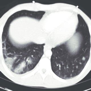 Magnetic resonance imaging (MRI) showing septic embolus to the brain ...