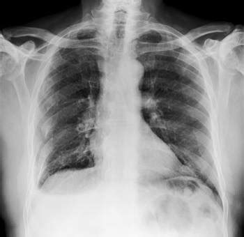 Rib Fracture - Injuries; Poisoning - MSD Manual Professional Edition