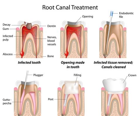 Root Canal Treatment Procedure Step By Step Artofit