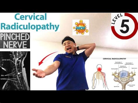 Carpal Tunnel Syndrome Mimicking C6 C7 Radiculopathy 42 Off