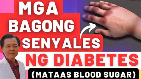 Mga Bagong Senyales Ng Diabetes Mataas Blood Sugar By Doc Willie