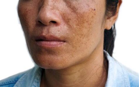 Melasma Como Reconhecer E Cuidar Das Manchas Escuras Que Afetam A Pele