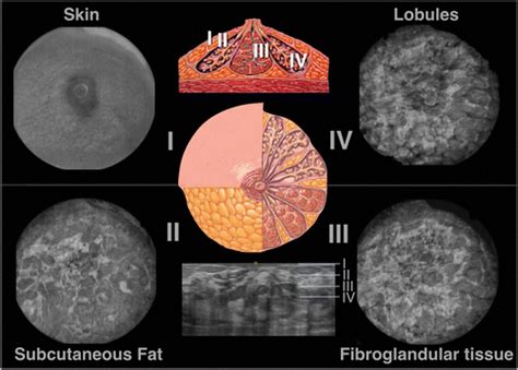 Three Dimensional Automated Breast Us Facts And Artifacts Radiographics