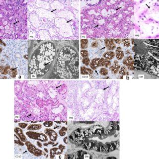 A Lm Analysis Of A Renal Biopsy Specimen Of Case Shows That Proximal