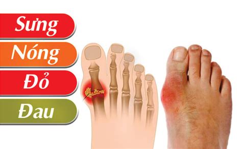 Gout Là Gì Dấu Hiệu Và Cách điều Trị Bệnh Gout