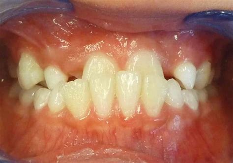 Clinical Analysis Correcting Class Iii Malocclusions With Interceptive Orthodontic Treatment