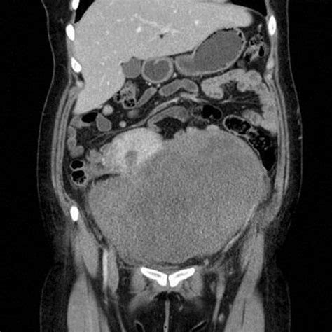 Abdominal Computed Axial Tomography With Contrast Medium Showing A