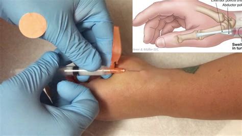 De Quervains Tenosynovitis Injection Youtube